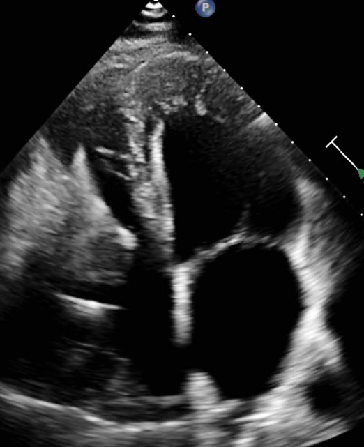 Echocardiogram